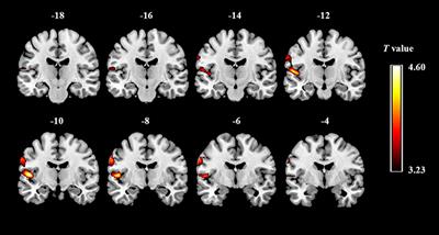 Increased Gray Matter Volume and Resting-State Functional Connectivity in Somatosensory Cortex and their Relationship with Autistic Symptoms in Young Boys with Autism Spectrum Disorder